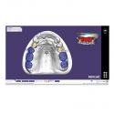 Modul exocad proteza scheletata