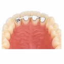 D.B. RETAINERS - UPPER LAT/LAT 14mm - 10buc