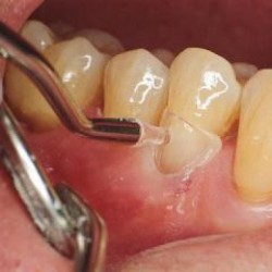 Matrici cervicale canini si premolari pentru instrumentul manual LM-MultiHolder LM-Dental